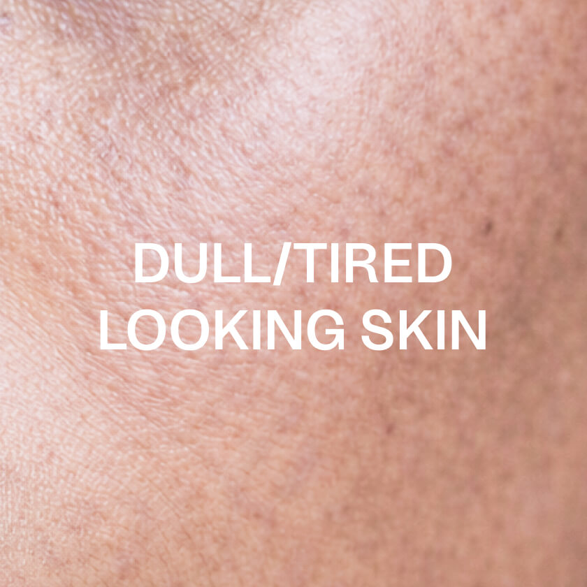 Træt eller mat hud