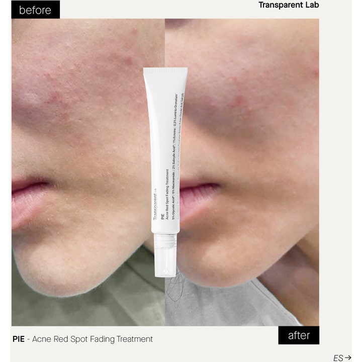 Niche Beauty Lab Transparent Lab P.I.E 30 ml spot treatment før og efter med synligt reducerede røde akne-mærker