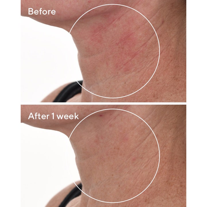 Murad Cellular Hydration Repair Serum 30 ml før og efter resultat af beroliget rødme på halsen