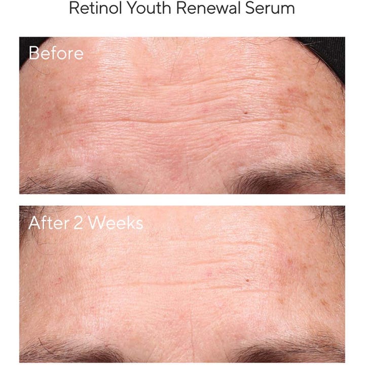 Murad Resurgence Retinol Youth Renewal Serum 30 ml før og efter resultat på rynker i panden