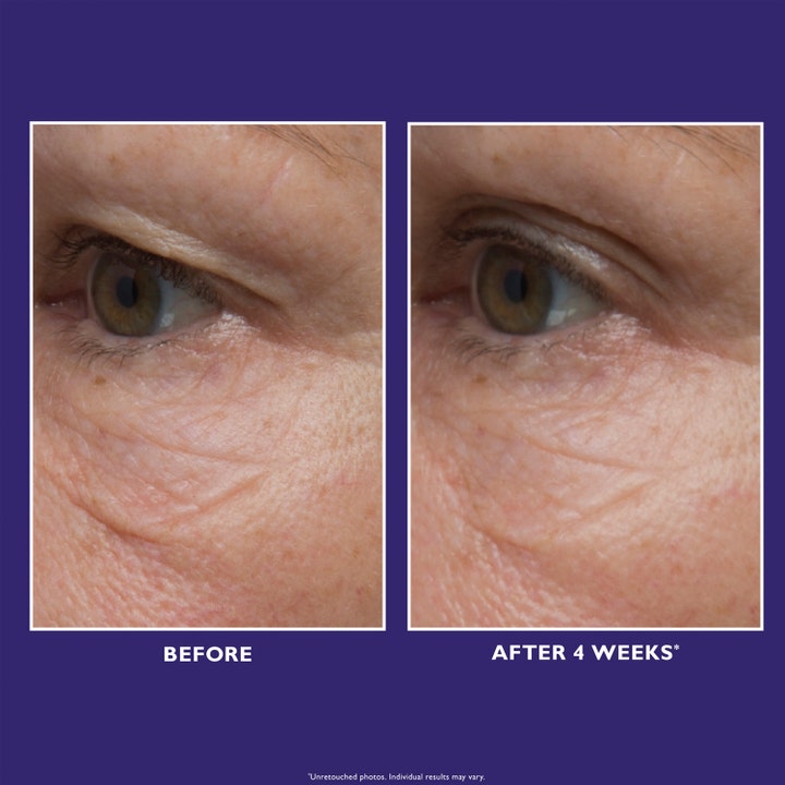 Peter Thomas Roth Ultimate Solution 5™ Eye Cream 15 ml før og efter billeder af rynker omkring øjnene.
