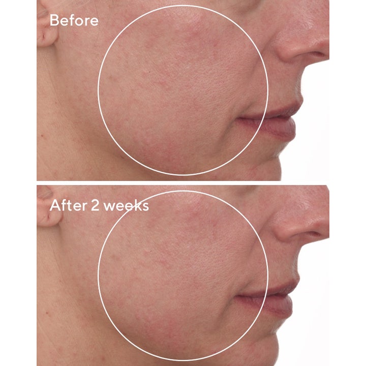 Murad Cellular Hydration Repair Cream 50 ml dagcreme før og efter resultat med reduceret rødme på huden