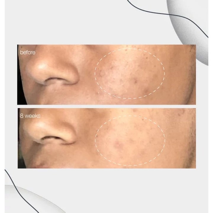 Dermalogica PowerBright Dark Spot Serum Duo med niacinamid viser synlig reduktion af pigmentpletter efter 8 uger.