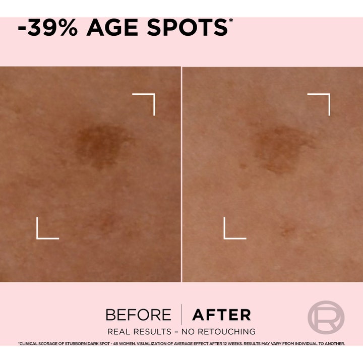 L'Oréal Paris Age Perfect Age Spot Rapid Corrector Serum 30 ml før og efter billede viser -39% age spots