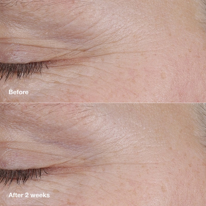 Clinique Smart Clinical Repair AM/PM Retinoid Balm 3 g ansigtspleje før og efter 2 uger resultat mod rynker