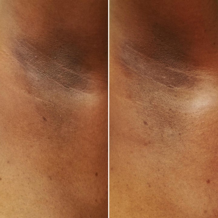 Sol de Janeiro Rio Deo Cheirosa 59 57 g deodorant viser før og efter resultat af en mere ensartet hudtone i armhulen