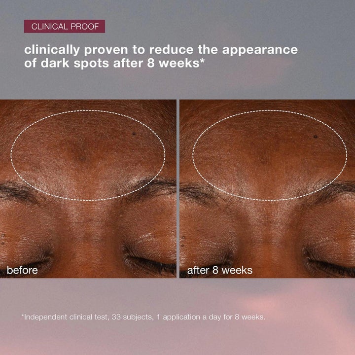 Dermalogica AGE smart Duo Dynamic Skin Recovery SPF50 mod mørke pletter viser før og efter klinisk resultat