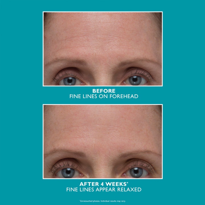 Peter Thomas Roth Peptide Skinjection Amplified Wrinkle-Fix Serum 30 ml før og efter resultat på panderynker