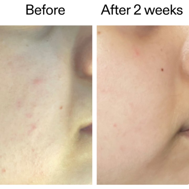 The INKEY List 360 Skin Clearing Serum 30 ml før og efter billeder der viser reduceret rødme og urenheder.