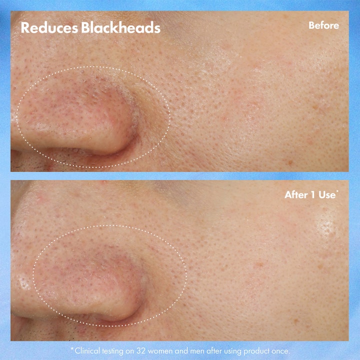 Origins Clear Improvement Mask-To-Scrub 75 ml viser før og efter resultat af reducerede hudorme.
