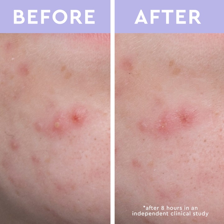 Spot A Spot Blemish Patches 36p