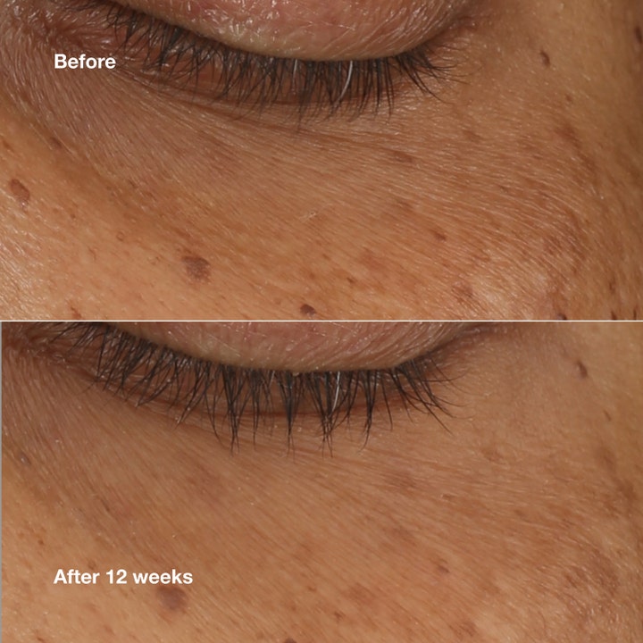 Clinique All About Eyes Brightening Serum Concentrate 10 ml øgenserum giver en lysere øjenomgivelse vist før og efter 12 uger