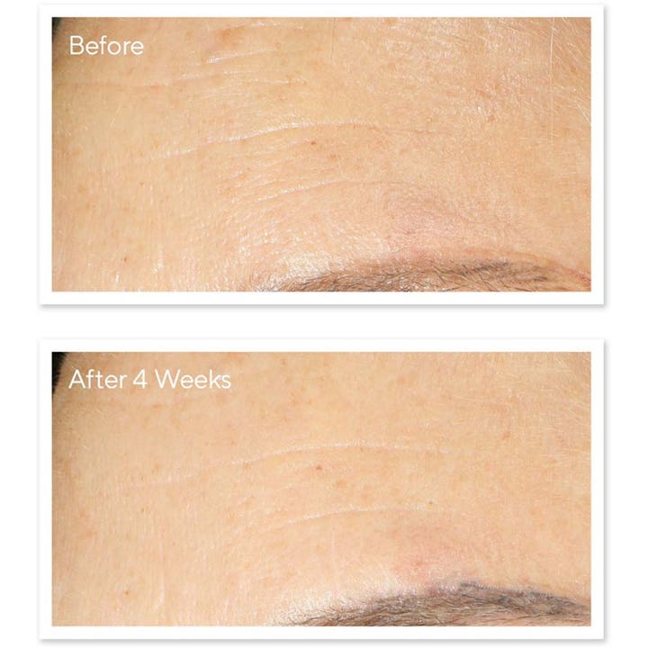 Murad Resurgence Retinol Youth Renewal Night Cream 50 ml før og efter resultat på rynker i panden