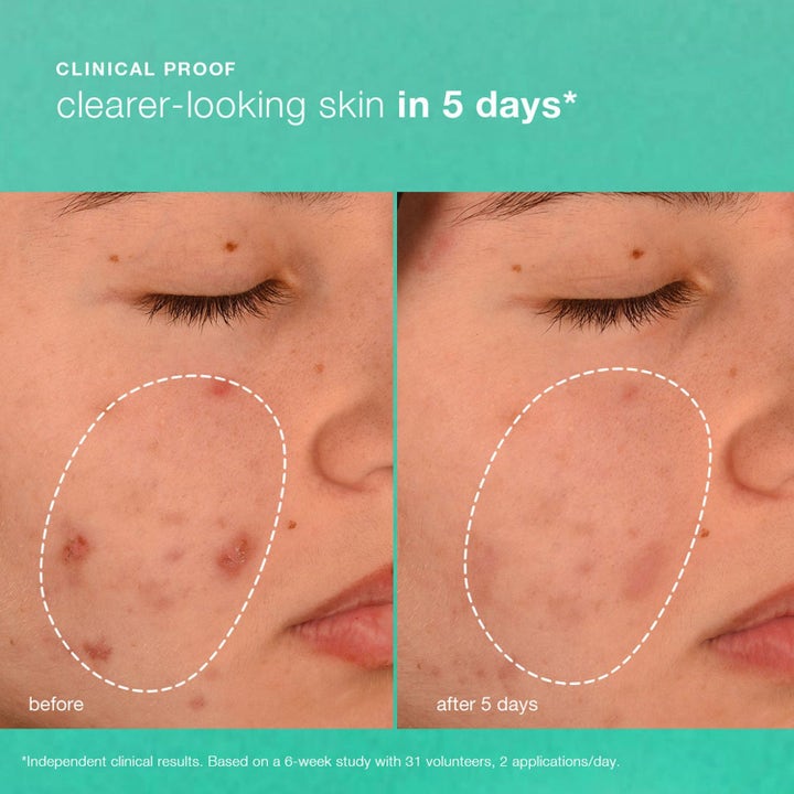 Dermalogica Breakout Biotic Moisturizer duo før og efter resultat af ansigtscreme mod uren hud.