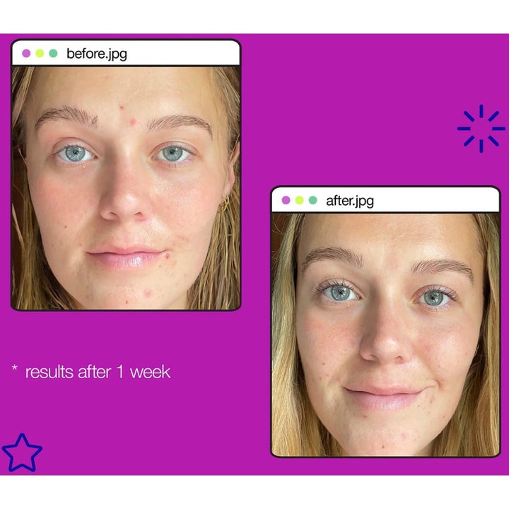 Dermalogica Post-Breakout Fix Duo 2x 15 ml viser før og efter resultater af hudpleje efter en uge.