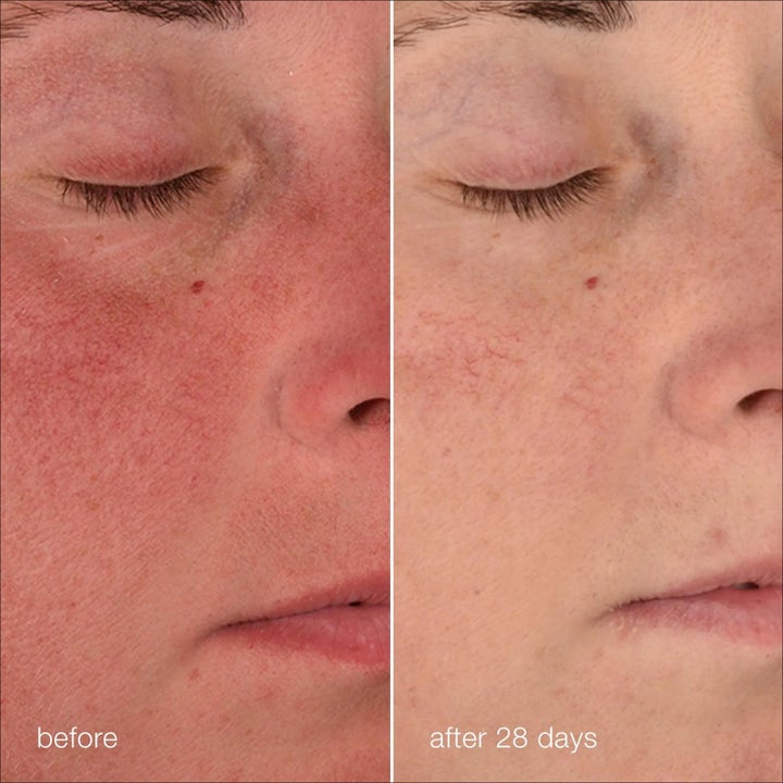 Dermalogica Stabilizing Repair Cream Duo hudpleje før og efter resultat mod rødme efter 28 dage