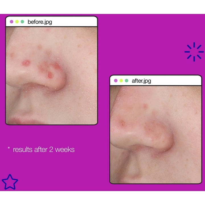 Dermalogica Post-Breakout Fix Duo 2x 15 ml viser før og efter resultater på mærker efter 2 ugers brug