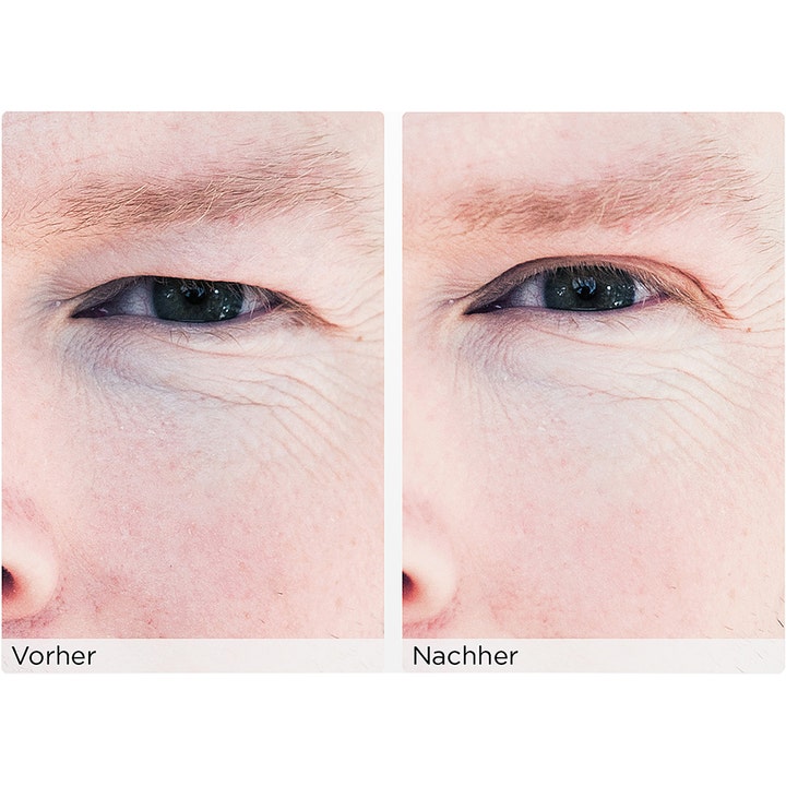 Wonderstripes The Instant Eye Lift Small 64 stk øjenlågstabletter før og efter resultat på tunge øjenlåg