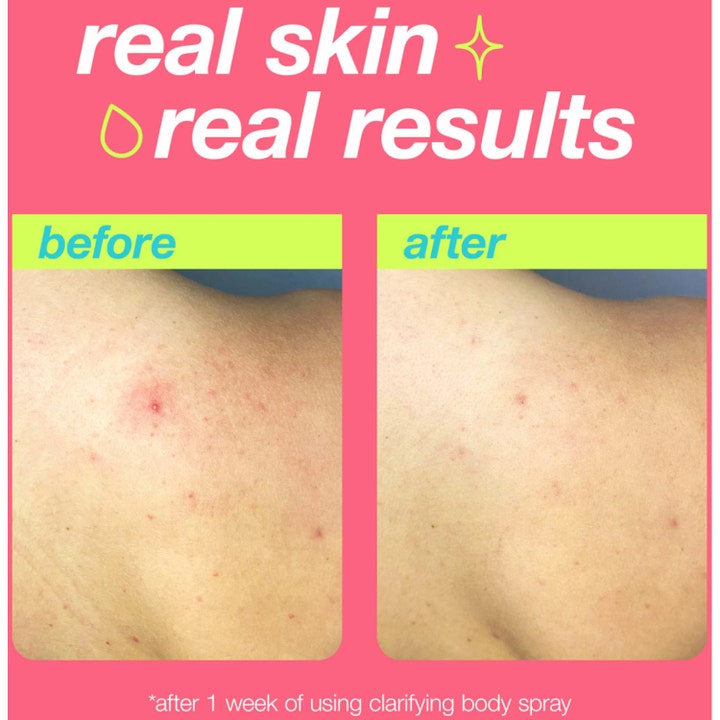 Dermalogica Clarifying Body Spray 177 ml mod urenheder før og efter resultat af hud på ryg