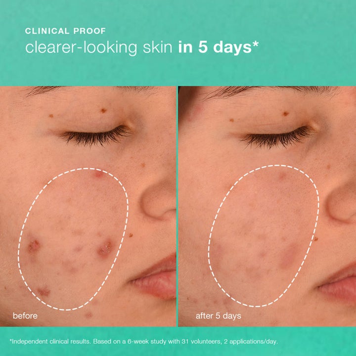 Dermalogica Breakout Biotic Moisturizer 50 ml ansigtscreme før og efter resultat på uren hud