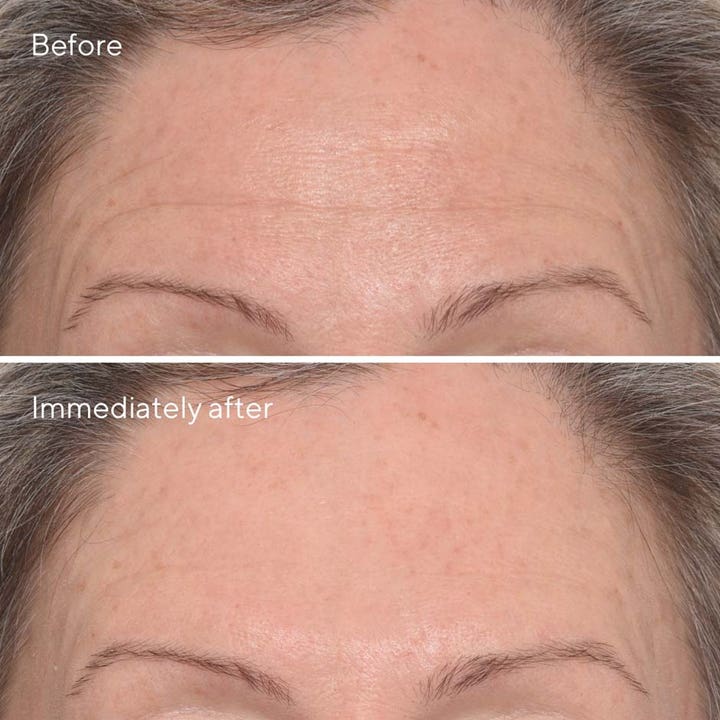 Murad Resurgence Targeted Wrinkle Corrector 15 ml rynkebehandling viser før og efter resultat på panderynker