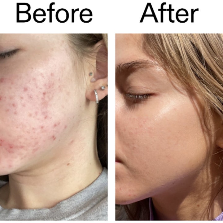 The INKEY List Beta Hydroxy Acid Serum 30 ml eksfolierende ansigtsserum med gennemsigtig geltekstur