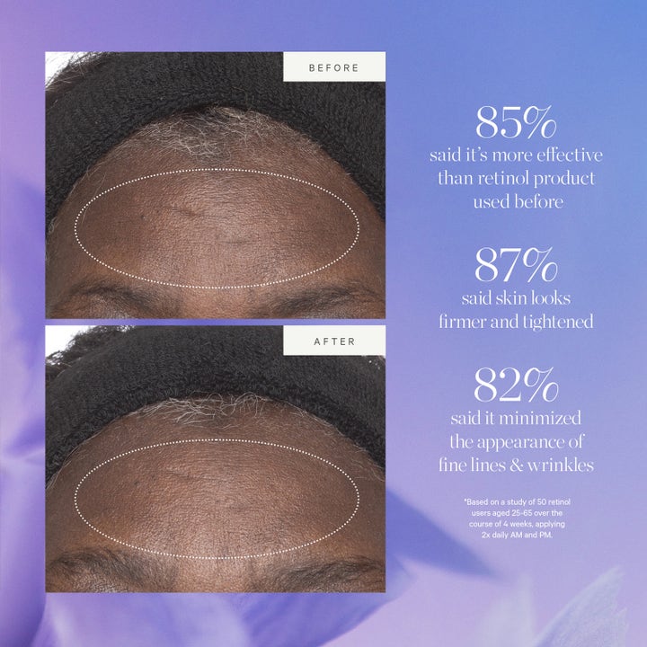 KORA Organics Retinol Alternative Moisturizer 50 ml ansigtscreme før og efter med 87% fastere og opstrammet hud