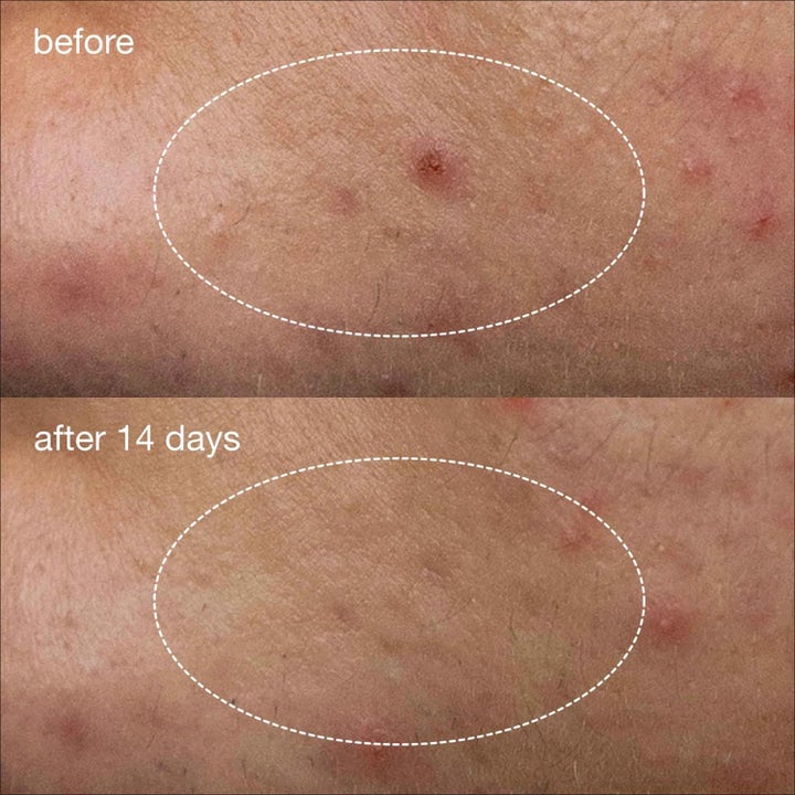 Dermalogica Deep Acne Liquid Patch Duo 2x15 ml mod bumser med niacinamid viser før og efter resultat på huden