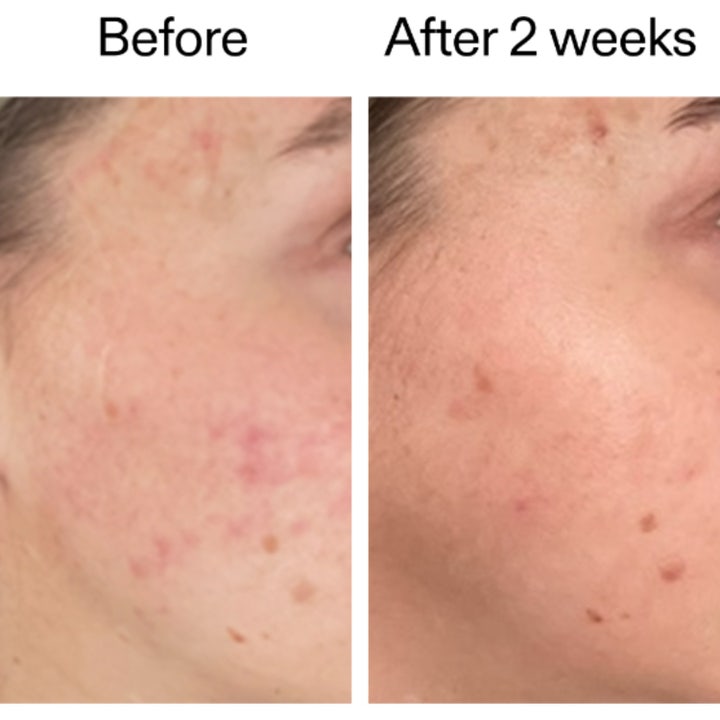 The INKEY List 360 Skin Clearing Serum 30 ml før og efter resultater der viser reduceret rødme og renere hud