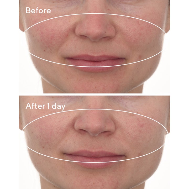 Murad Cellular Hydration Repair Mask 80 ml ansigtsmaske før og efter resultat der viser reduceret rødme efter en dag