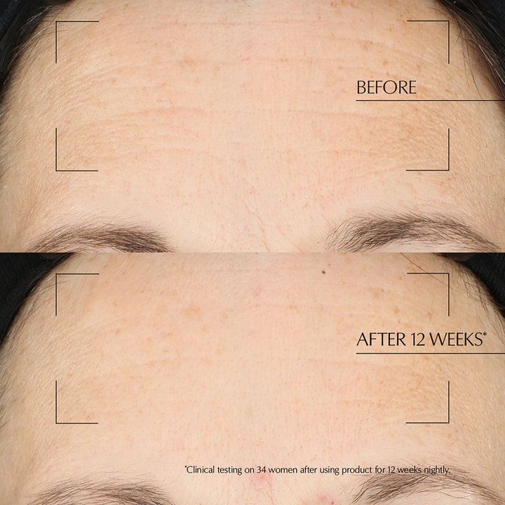 Estée Lauder Advanced Night Repair Overnight Treatment 65 ml før og efter resultat på panderynker