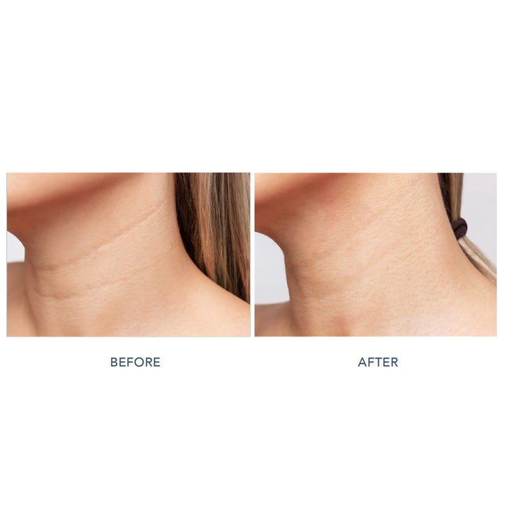 FAQ Swiss FAQ 211 LED Neck & Décolleté Mask 1 stk før og efter billede viser glattere hud med færre linjer på halsen