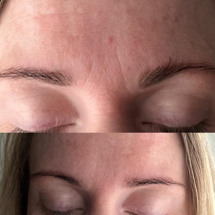 Dana Nel Facial Beauty Tape 1 stk mod rynker viser før og efter resultat med glattere hud i panden.