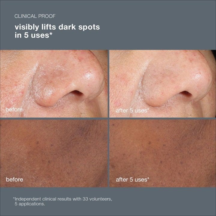 Dermalogica PowerBright Dark Spot Peel 50 ml peeling mod pigmentering viser synlige før og efter resultater på mørke pletter.