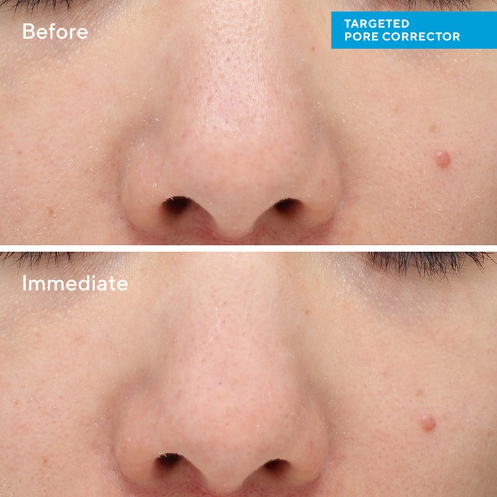 Murad Targeted Pore Corrector 15 ml spot treatment der giver glattere hud og mindsker porer i før og efter billede