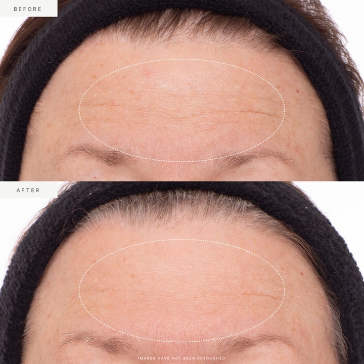 KORA Organics Plant Stem Cell Retinol Alternative Serum 10 ml viser synlig reduktion af rynker før og efter brug