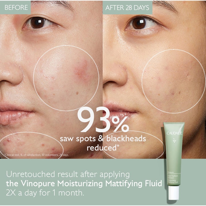 Caudalie Vinopure Moisturizing Mattifying Fluid 40 ml dagcreme viser før og efter resultat på urenheder