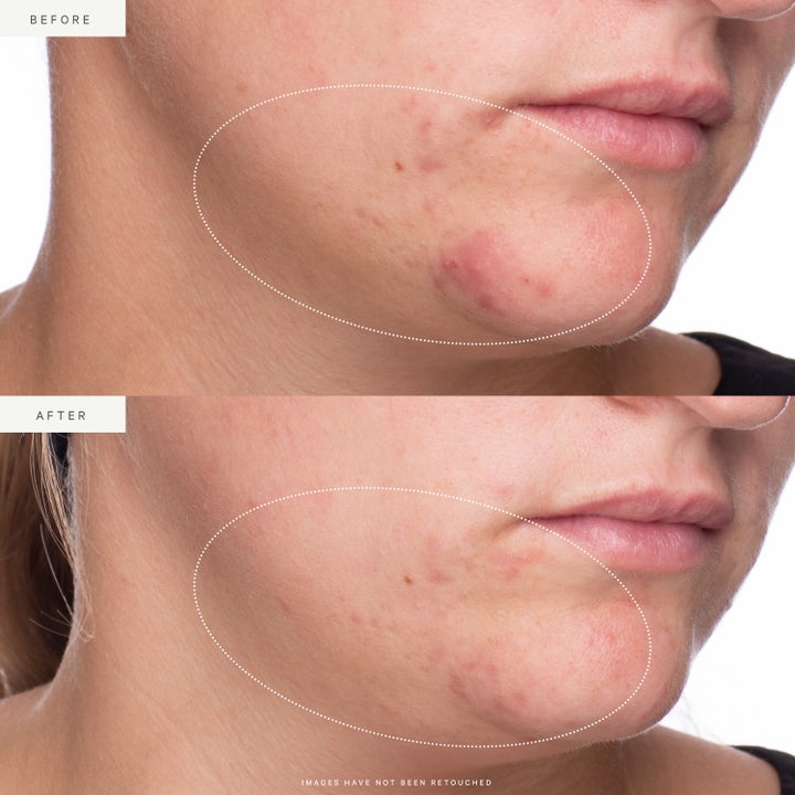 KORA Organics Active Algae Lightweight Moisturizer 50 ml ansigtscreme før og efter resultat på rødme og uren hud