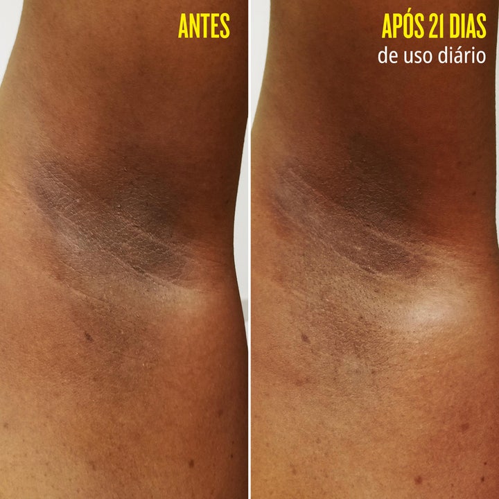 Sol de Janeiro Rio Deo 62 Deodorant Refill 57 ml viser før og efter resultat for en mere jævn hudtone i armhulen.