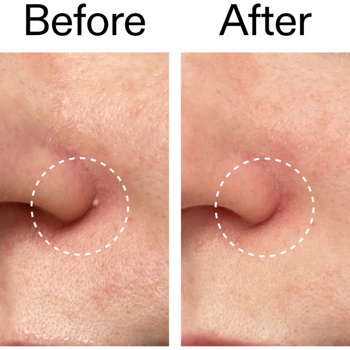 INKEY Hydrocolloid Invisible Pimple Patches