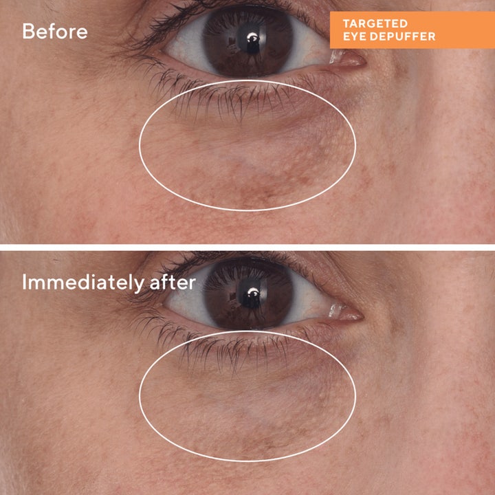 Murad Targeted Eye Depuffer 15 ml øjencreme før og efter resultat mod poser under øjnene.