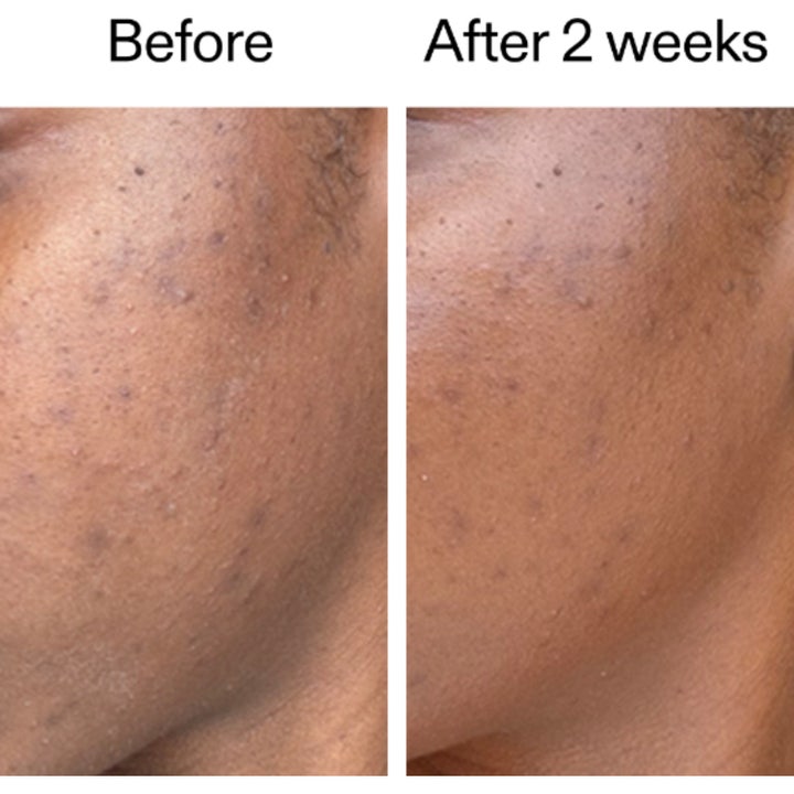 The INKEY List 360 Skin Clearing Serum 30 ml viser før og efter resultat på uren hud efter 2 uger.
