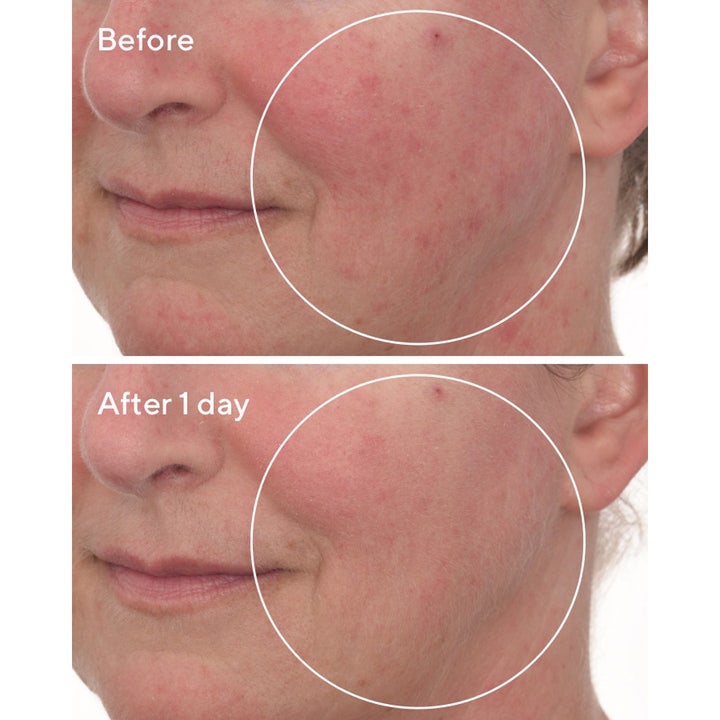 Murad Cellular Hydration Repair Mask 80 ml ansigtsmaske før og efter resultat på rødme efter 1 dag