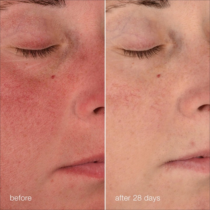 Dermalogica Stabilizing Repair Cream 50 ml beroligende ansigtscreme før og efter 28 dages brug på rødme