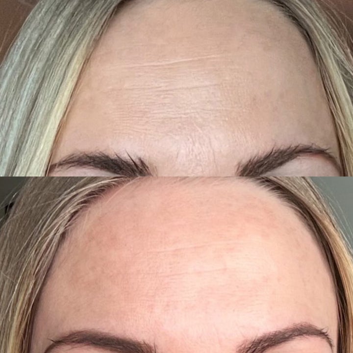 Dana Nel Facial Beauty Tape 1 stk ansigtstape mod rynker viser før og efter resultat af en glattere pande