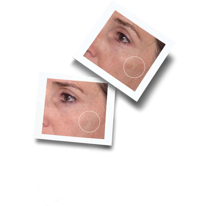 Murad Rapid Dark Spot Correcting Serum 30 ml mod pigmentpletter vist med før og efter fotos af ansigtshud.
