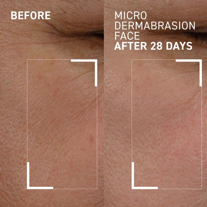 Dr Brandt Microdermabrasion Face Exfoliator 60 g peeling før og efter 28 dage viser tydeligt glattere hudstruktur