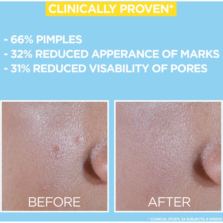 Garnier Skin Active BHA + Niacinamide 40 ml solcreme viser før og efter resultater på bumser og porer