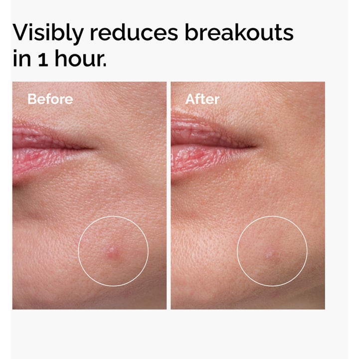 The Ordinary Sulfur 10% Powder-To-Cream Concentrate 5 g spot treatment mod urenheder før og efter bums på en time.