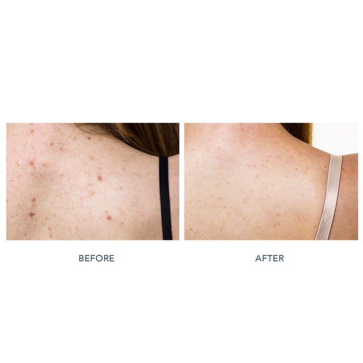 FAQ Swiss FAQ™ 211 LED Neck & Décolleté Mask 1 stk. giver jævnere hud vist i før og efter sammenligning af urenheder